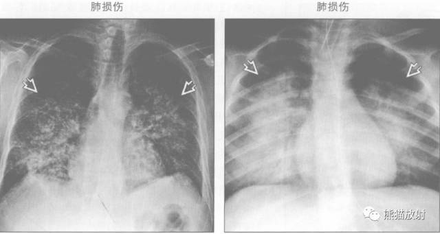 肺部之“蝙蝠翼征”-11