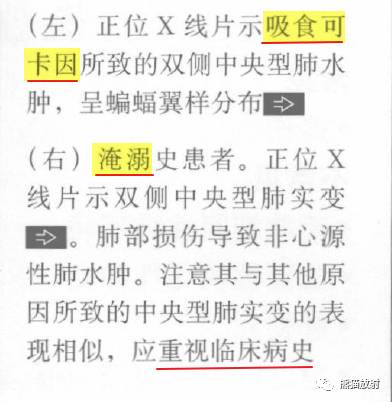 肺部之“蝙蝠翼征”-12