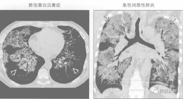 肺部之“蝙蝠翼征”-15