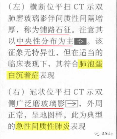 肺部之“蝙蝠翼征”-16