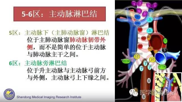 【PPT】胸内（纵隔）淋巴结分区速记-12