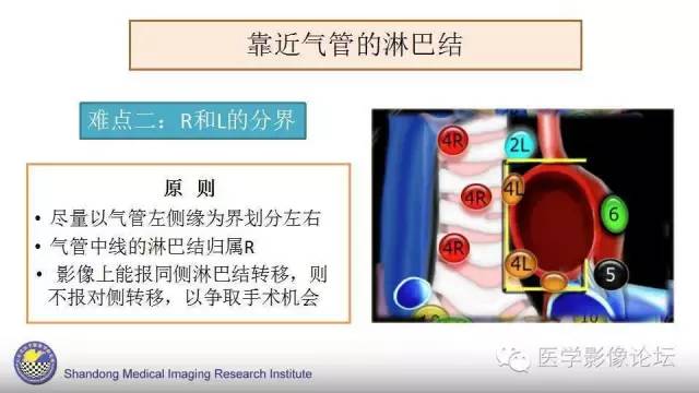 【PPT】胸内（纵隔）淋巴结分区速记-21