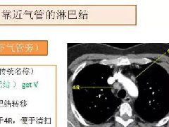 胸内（纵隔）淋巴结分区速记