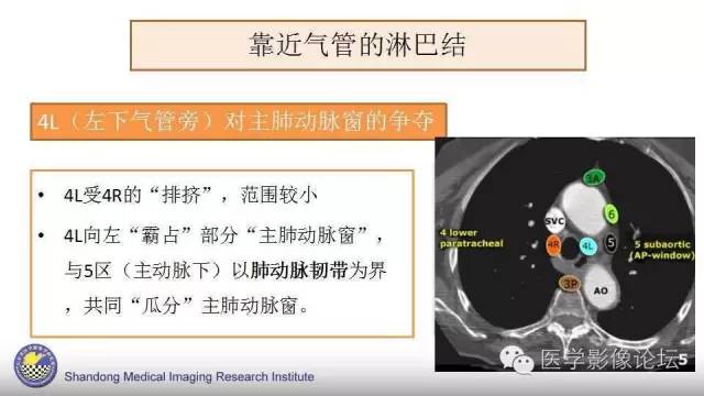 【PPT】胸内（纵隔）淋巴结分区速记-23