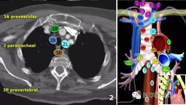 【PPT】胸内（纵隔）淋巴结分区速记-26