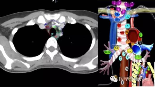 【PPT】胸内（纵隔）淋巴结分区速记-33