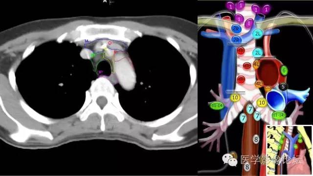 【PPT】胸内（纵隔）淋巴结分区速记-34