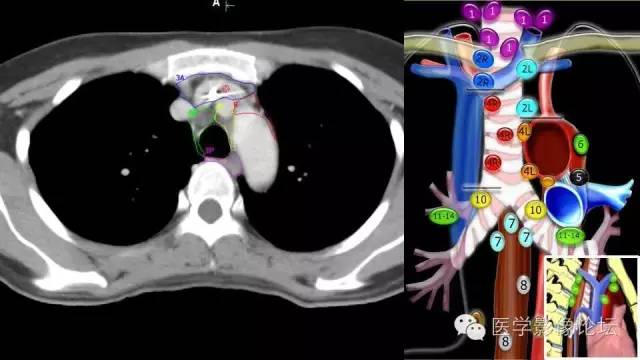 【PPT】胸内（纵隔）淋巴结分区速记-35