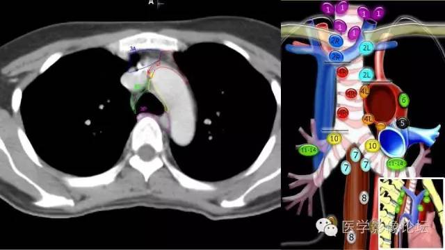 【PPT】胸内（纵隔）淋巴结分区速记-36
