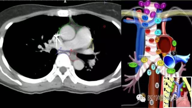 【PPT】胸内（纵隔）淋巴结分区速记-40