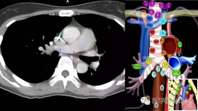 【PPT】胸内（纵隔）淋巴结分区速记-41