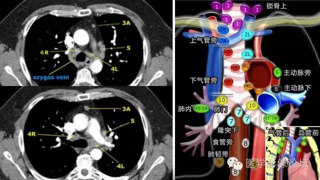 【PPT】胸内（纵隔）淋巴结分区速记-47