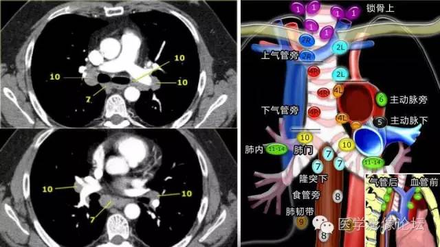 【PPT】胸内（纵隔）淋巴结分区速记-48