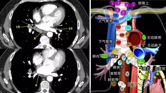 【PPT】胸内（纵隔）淋巴结分区速记-49