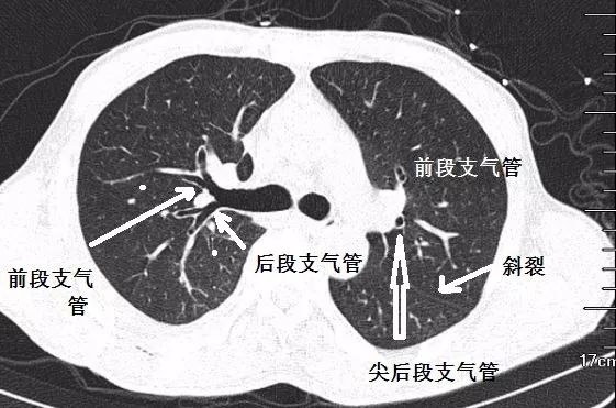 支气管CT解剖-3