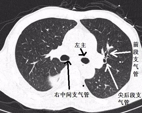 支气管CT解剖-5