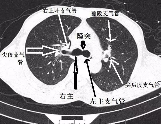 支气管CT解剖