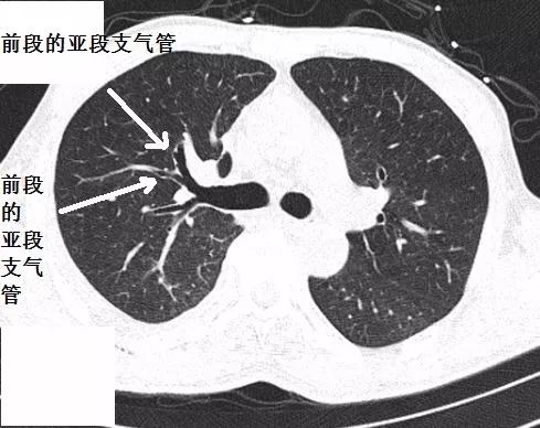 支气管CT解剖-4