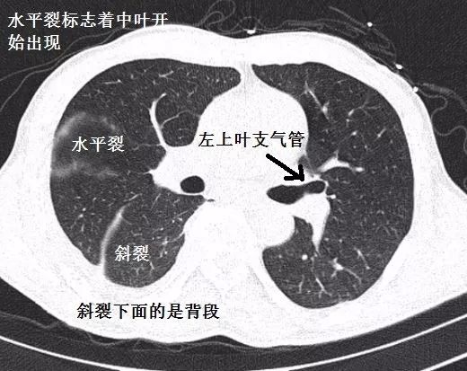 支气管CT解剖-6