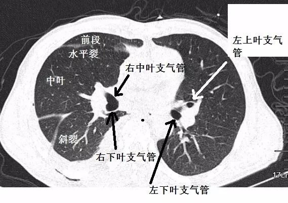 支气管CT解剖-7