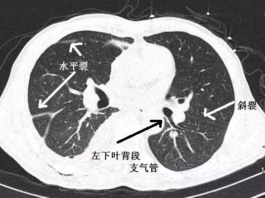 支气管CT解剖-8