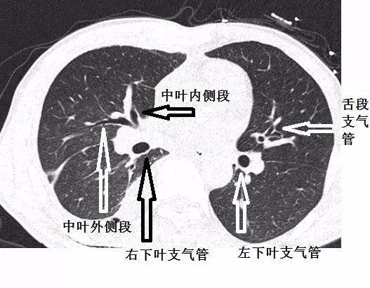支气管CT解剖-10
