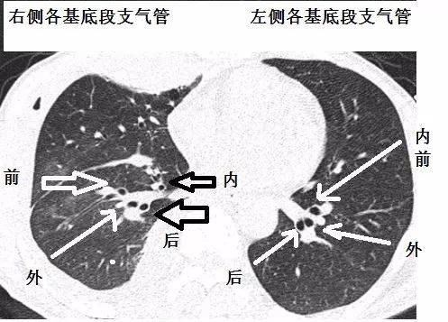 支气管CT解剖-11