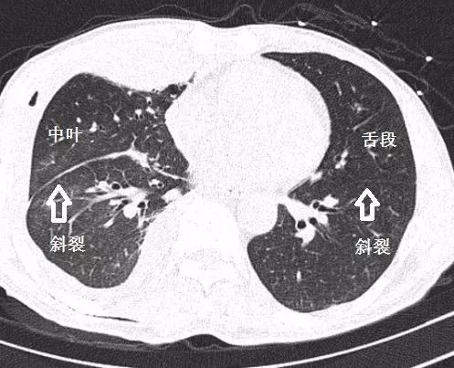 支气管CT解剖-12