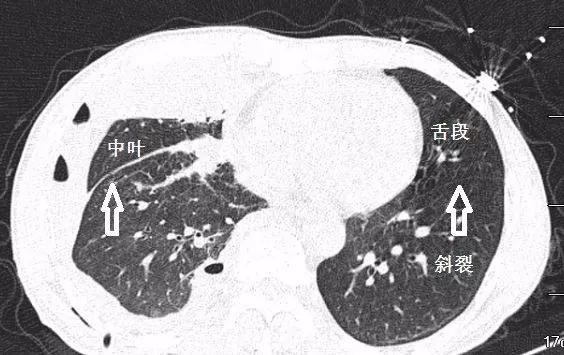 支气管CT解剖-13