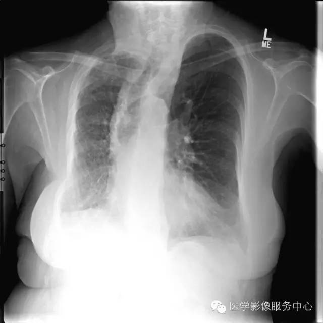 【病例】单侧肺动脉缺如1例