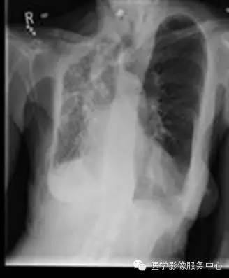 【病例】单侧肺动脉缺如1例 【病例】单侧肺动脉缺如1例