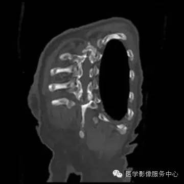 【病例】单侧肺动脉缺如1例 【病例】单侧肺动脉缺如1例