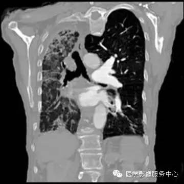 【病例】单侧肺动脉缺如1例 【病例】单侧肺动脉缺如1例