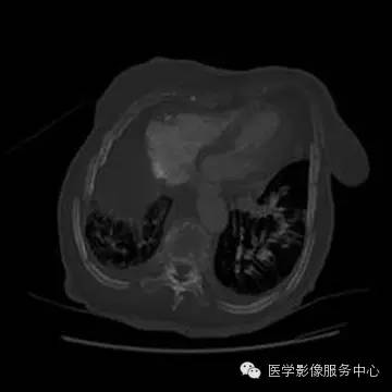 【病例】单侧肺动脉缺如1例