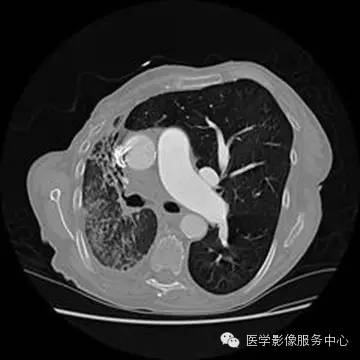 【病例】单侧肺动脉缺如1例 【病例】单侧肺动脉缺如1例