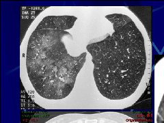 肺部真菌感染影像学分析