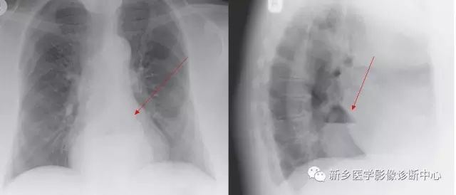 影像PPT - 食管裂孔疝CT影像表现-1