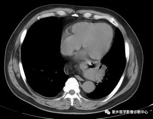 食管裂孔疝CT影像表现