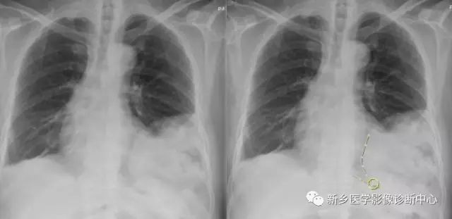 影像PPT - 食管裂孔疝CT影像表现-4
