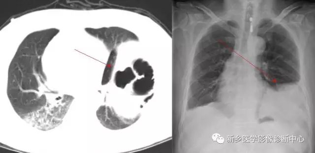 影像PPT - 食管裂孔疝CT影像表现-5