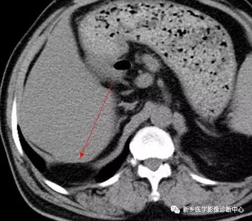 影像PPT - 食管裂孔疝CT影像表现-3