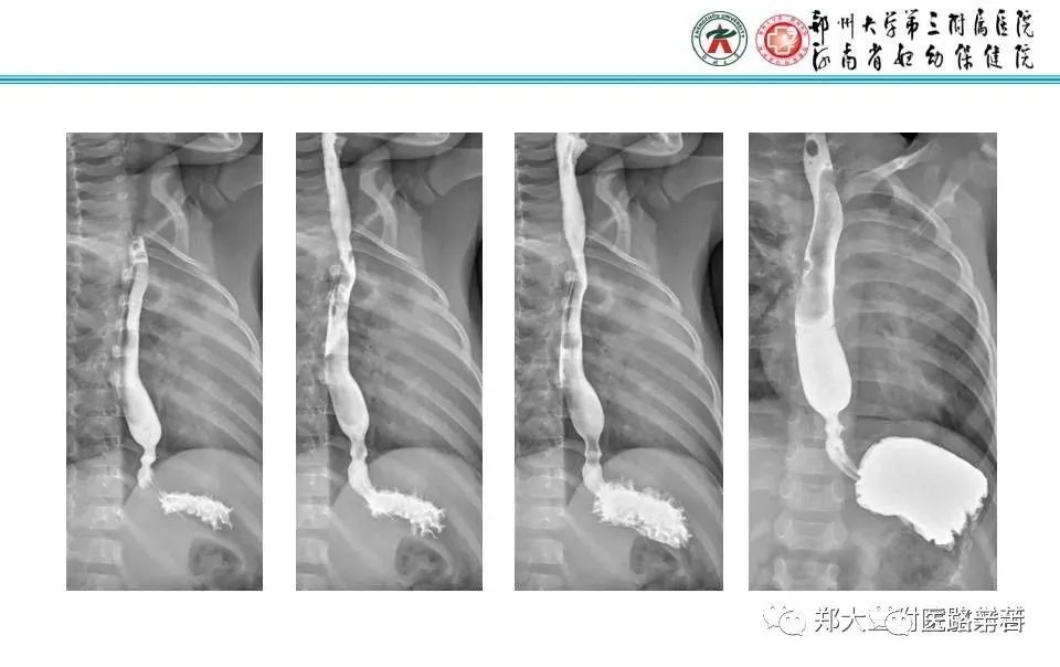 影像PPT - 食管裂孔疝CT影像表现-8
