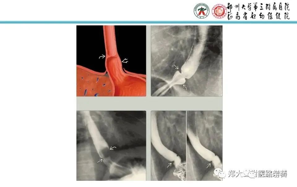 影像PPT - 食管裂孔疝CT影像表现-15