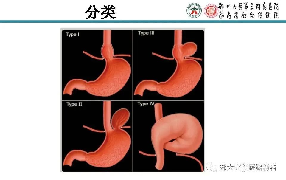 影像PPT - 食管裂孔疝CT影像表现-19
