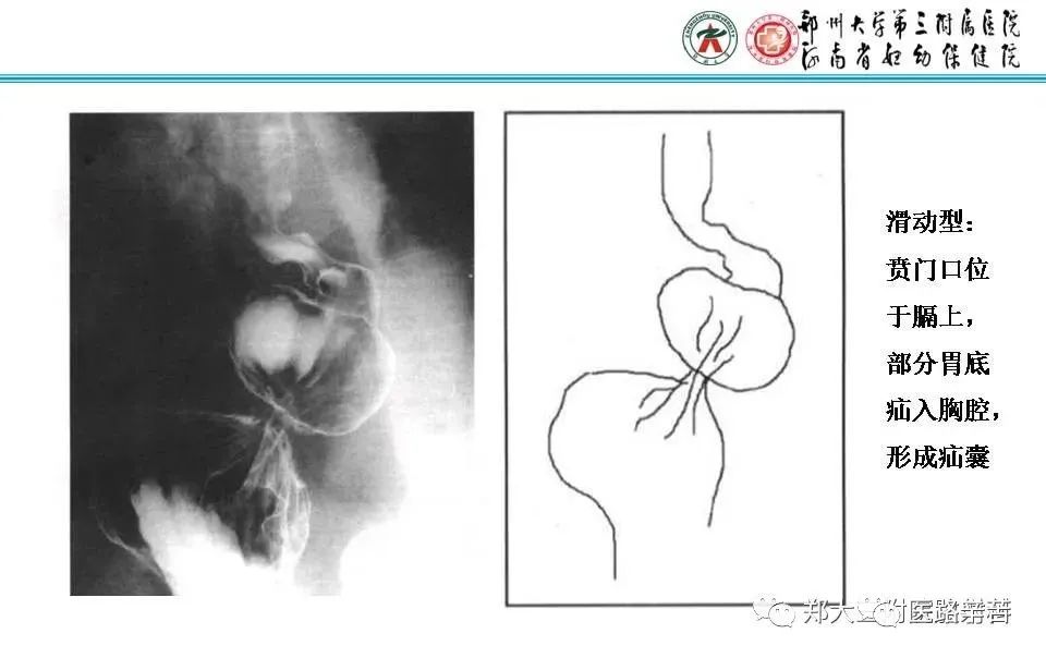 影像PPT - 食管裂孔疝CT影像表现-35