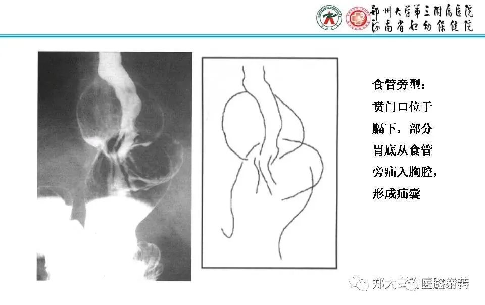 影像PPT - 食管裂孔疝CT影像表现-36