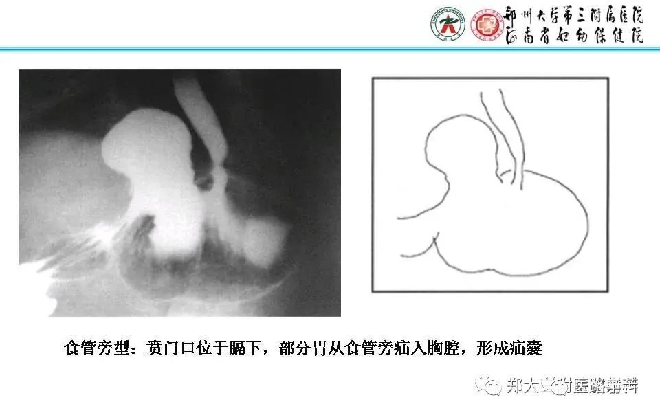 影像PPT - 食管裂孔疝CT影像表现-37