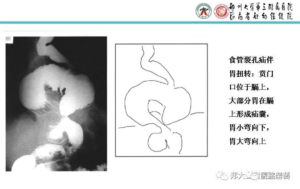 影像PPT - 食管裂孔疝CT影像表现-38