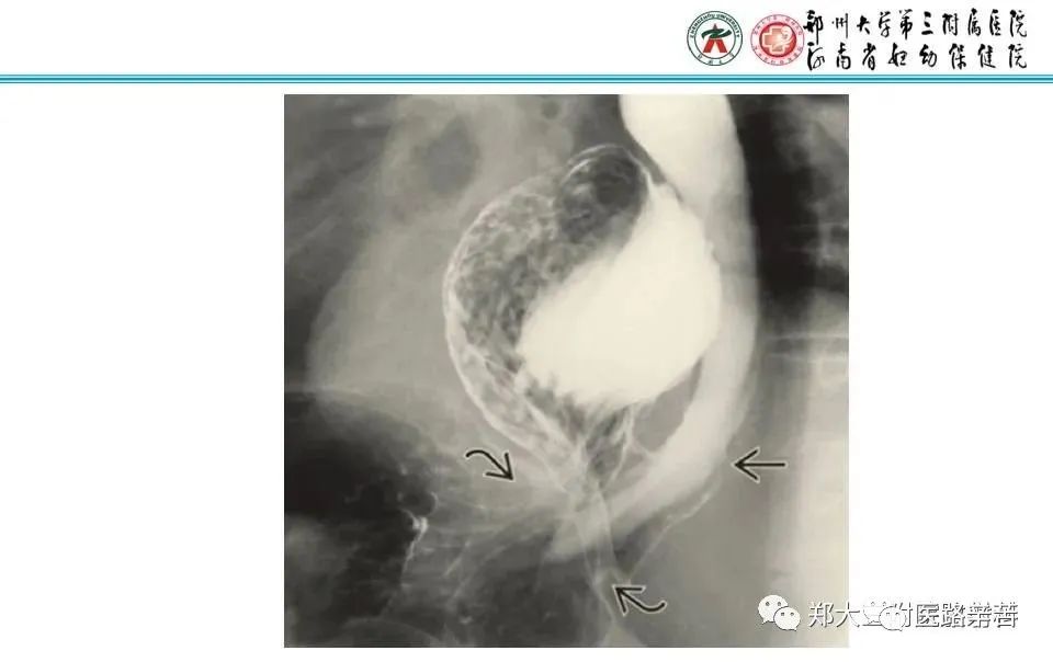 影像PPT - 食管裂孔疝CT影像表现-39