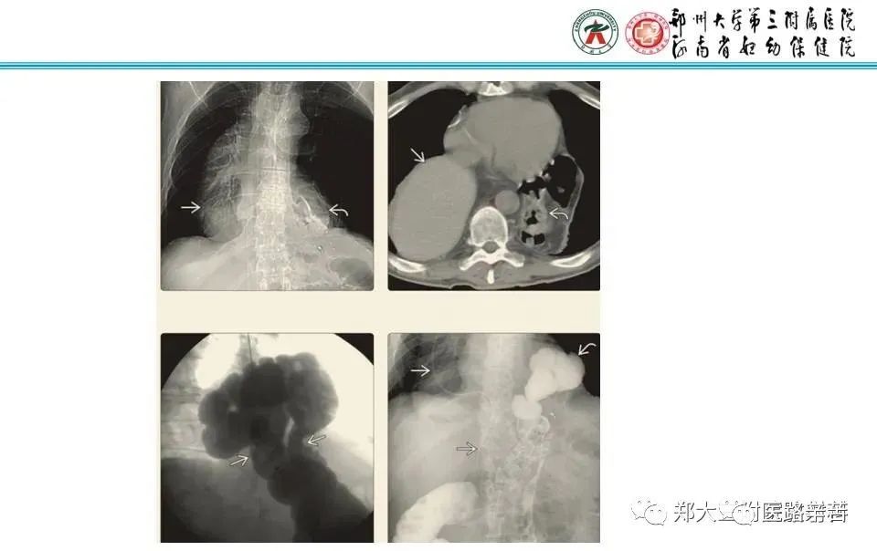 影像PPT - 食管裂孔疝CT影像表现-41